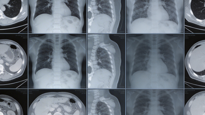 基于 Snowflake 的 MONAI 分布式医学影像处理 ｜ 技术实践